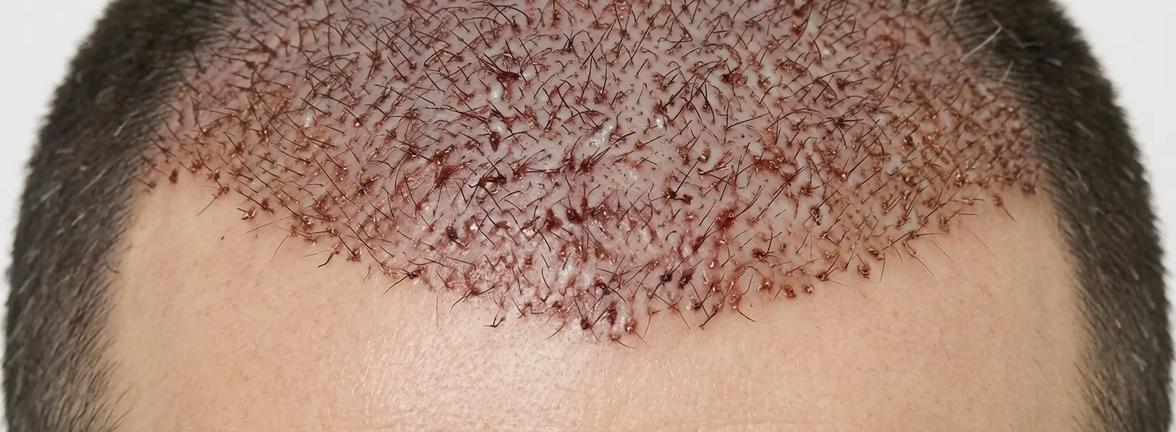 Initial Healing
